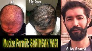 Sac Cikaran Mucize Formul 4 Sarimsak Yagi Nasil Yapilir Youtube