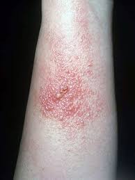 Plants That Can Cause A Rash Everyday Health Poison Oak Rash Pictures Poison Oak Pictures Poison Ivy Rash Pictures