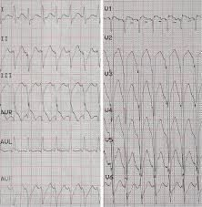 10 common ekg heart we are going to identify the characteristics on an ekg and nursing interventions and treatments for svt. Onset Of Supraventricular Tachycardia Ecg Was Recorded At A Paper Download Scientific Diagram