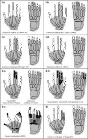 Image result for Syndactyly