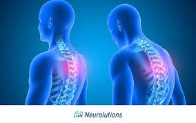 Image result for Decorticate Posturing