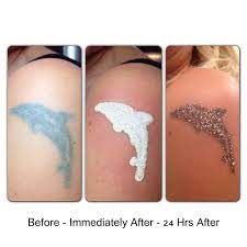 Call us today on (03) 9998 6048 to find out how. Non Laser Tattoo Removal Precision Cosmetic Clinics Hertfordshire Tatuaggi