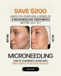 ✨ Ready to get glowing skin and save big? ✨ Until July 31st, save $200 when  you purchase a series of 4 microneedling treatments because your skin  deserves consistent care and you