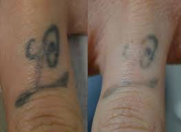 Finger Tattoo After 1 Session Lasertattooremoval Tattooremovaltoronto Tattoo Howtoremovetattoo Paw Print Tattoo Paw Print Print Tattoos