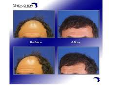 Dr Cam Simmons 9 Months After 3000 Grafts Were Transplanted To The Front For A Norwood 5 6 Patient With Wavy Salt Salt And Pepper Hair Hair Transplant Hair