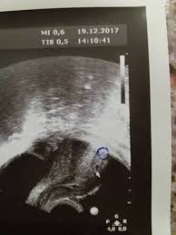 Nach dem embryotransfer (und verlassen des. Ultraschall Nach Icsi Kinderwunschbehandlung