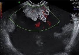 Characterization of adnexal masses with conventional and advanced imaging techniques. New Test For Diagnosing Ovarian Cancer Accurately