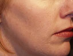 Image result for Melasma