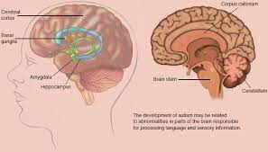 Advances in human genomics have identified a large number of genetic variations associated with asd. Autism Spectrum Disorder Asd Resources