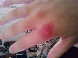 Wash the wound well with soap and water to help prevent infection. Pin On Spiders Spiders Spiders