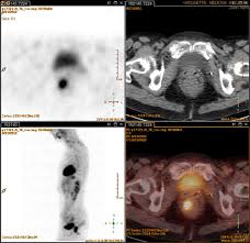 A pet scan works by detecting the energy released by positrons. Pet Ct In Anal Cancer Indications And Limits Intechopen