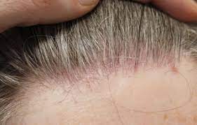 No hair follicle openings can be seen in the areas of hair loss. Follicular Lichen Planus Lichen Planopilaris