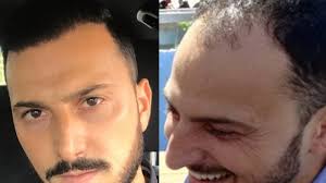 E' possibile pagare a rate il costo del trapianto capelli, trapianto capelli: Trapianto Di Capelli In Turchia Una Scelta Raccomandabile La Repubblica