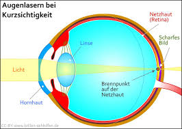 Eyelaser | augen lasern im augenlaserzentrum wien & linz. Augenlasern In Koln Vor Und Nachteile Kosten Kliniken