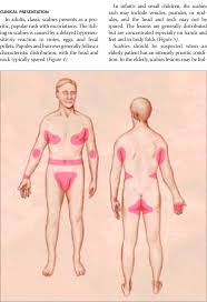 Image result for scabies effects on the human body