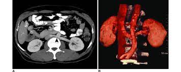 Single Retroaortic Renal Vein In 52 Year Old Female Who Presented With Download Scientific Diagram