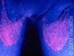 Image result for Erythrasma