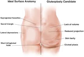 Aesthetic Surgery of the Buttocks Using Implants: Practice-Based  Recommendations