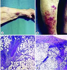 Image result for Panniculitis