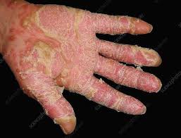 Image result for Pustular Psoriasis