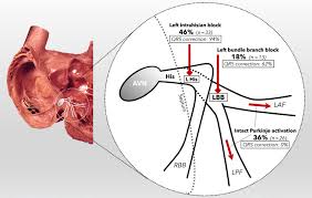 Image result for Left Bundle Branch Block