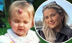 Molly-Mae Hague reveals she 'loved' her huge strawberry birthmark but had  it surgically removed aged 12 as she shares previously unseen baby photos