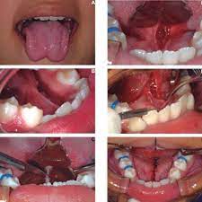 Frenectomy With Use Of A Grooved Director A Heart Shaped Tongue Download Scientific Diagram
