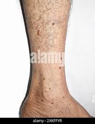 Image result for liver spots on legs