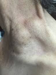 Learn all about cancer risk factors, symptoms, diagnosis & treatment at cancer.org Virchow Node The Gastrointestinalatlasl Gastrointestinalatlas Com