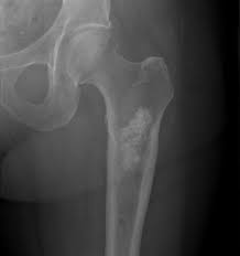 Image result for Chondrosarcoma