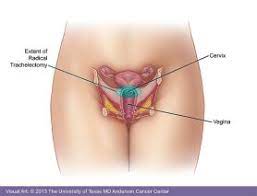 Most cases develop in women aged between 25 and 45. Cervical Cancer Md Anderson Cancer Center