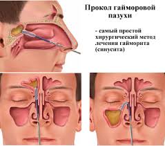 Sinusit Sinusitis Prichiny Vozniknoveniya Kak Proyavlyaetsya I Diagnostiruetsya Profilaktika I Lechenie Vospaleniya