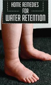 Home Remedies For Water Retention Resultarea In 2020 Water Retention Remedies Water Retention Foot Remedies