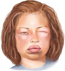 Image result for Angioedema