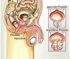 Die vorsorgeuntersuchung sollte von jedem mann ab 45 jahren wahrgenommen werden. Prostatakrebs Vorsorgeuntersuchung Das Erwartet Sie Beim Urologen Gesund Co At