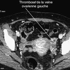 Check 'thrombose' translations into english. Thrombose De La Veine Ovarienne Coupe Transversale Download Scientific Diagram