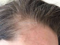 I really thought i was doing something good for my hair, and that wen would make my hair healthier, and start growing back. Wen Hair Loss Itchiness Baldness Sep 03 2019 Pissed Consumer