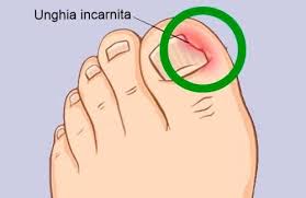 Rimedi Naturali Per Le Unghie Incarnite Rimedi Naturali Rimedi Unghie Incarnite