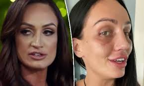 MAFS' Hayley Vernon finally unveils the results of her nose job
