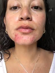 Rutin hjälp] Desperat! Oavbruten haka-akne i mitten av 30-talet. Detaljer i  kommentar : r/SkincareAddiction