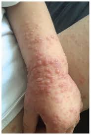 Image result for Hand foot and mouth disease HFMD roof of mouth
