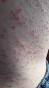 More images for postcovid rash » Cureus Coronavirus Disease 2019 Covid 19 Accompanied By Maculopapular Rash A Case Study