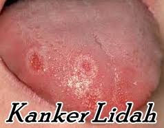 Image result for kanker