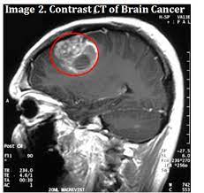 Use our procedure cost comparisons to save money on your procedure! Discounted Rates On Brain Neck Ct Scan Cost Across India
