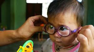 Image result for Refractive Error