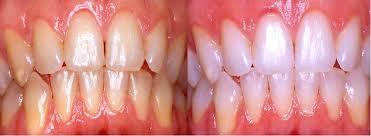 Image result for Carbamide Peroxide