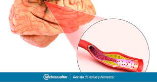 En el contexto de la isquemia cerebral aguda (ia) las estrategias terapéuticas están orientadas a recanalizar el vaso ocluido para así salvar el tejido cerebral circundante al territorio ya infartado. Tipos De Ictus Ictus Isquemico E Ictus Hemorragico