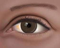 Six Things To Know About Pinguecula And Pterygium Natural Pink Eye Remedy What Is Pink Eye Pink Eyes