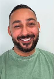 Before and after veneer treatment. After image taken 2 weeks  post-treatment. Please note results shown are specific to this patient and  will vary for each individual. All images and videos