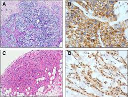 In addition to mesothelioma, some bap1 mutation carriers developed uveal melanoma. Histological Findings Of Patient With Bap1 Germline Mutation A Liver Download Scientific Diagram